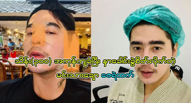  <img src="https://news.cooxf.com/wp-content/uploads/2023/07/3-07-25-190319-1.webp" alt="Ze Ye Than who got his nose repaired at the cost of Kyat" class="custom-title-image">